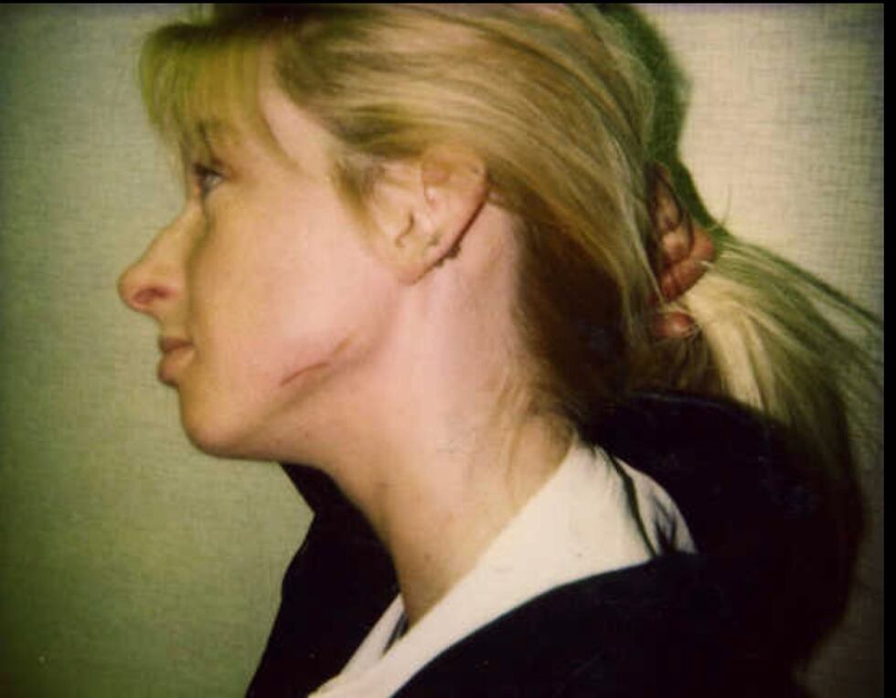 This photo shows the scar on Stephanie Pruitt's face where Russell Bucklew cut her with a...